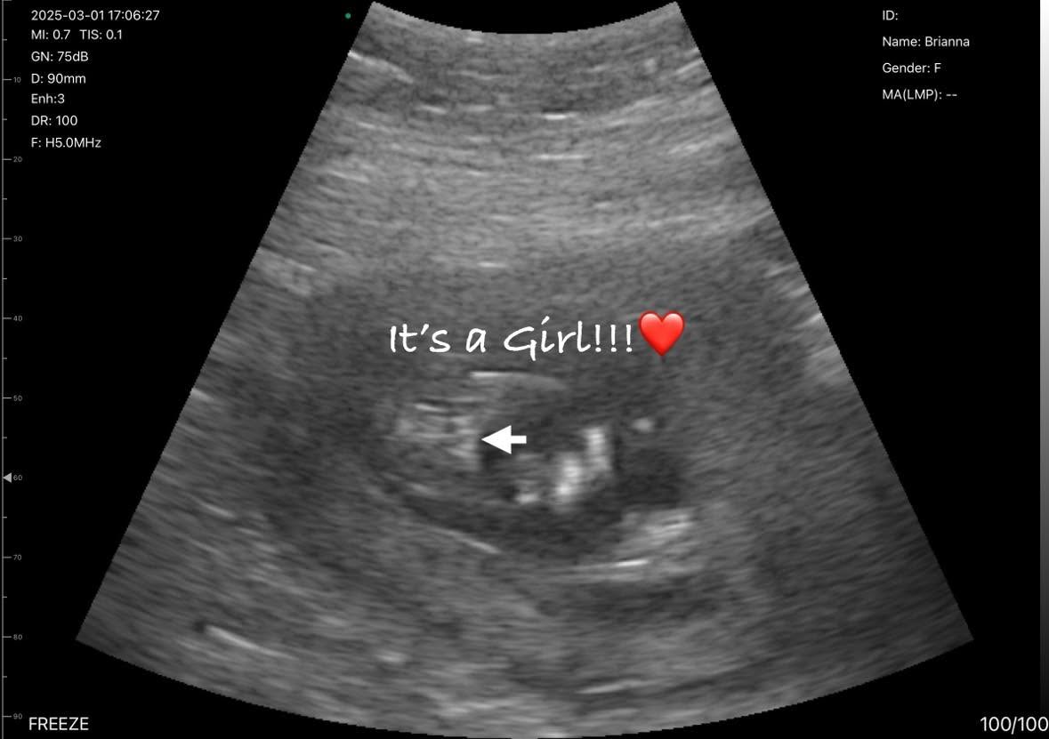 An ultrasound screen with the caption It's a Girl and a small arrow marking the anatomy.