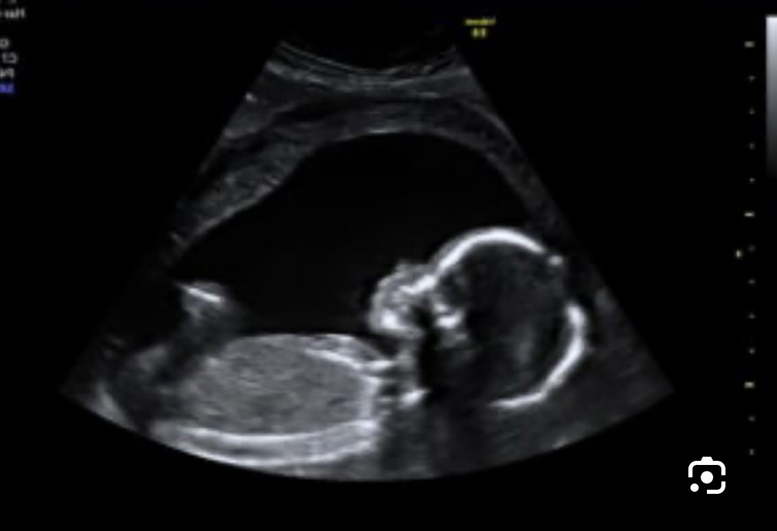 A softly lit ultrasound image showing a baby in profile with the spine and head clearly outlined.